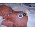 Langerhans cell hystiocytosis in child of young age