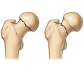 The Indicators Bone Metabolism in Fractures of Trochanteric Areas of Femur in Patients with Type 2 Diabetes