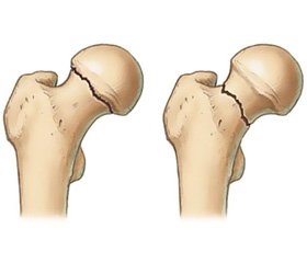 The Indicators Bone Metabolism in Fractures of Trochanteric Areas of Femur in Patients with Type 2 Diabetes