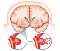 Acute neurotrophic disorders of the digestive system against the background of a cerebral stroke