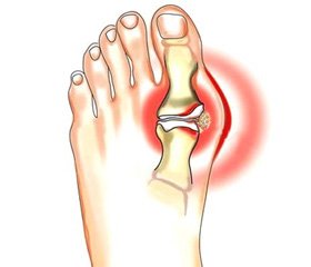 The Influence of Sartants on the Gout Course