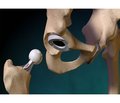 Features of hip replacement in severe types of dysplasia