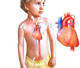 Diagnosis, clinical manifestations, treatment and prognosis for children with coarctation of the aorta