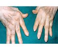 Changes in Bone Mineral Density of the Distal Forearm and Development of Erosive Joint Damage at Hand Joints MRI in Patients with Early Rheumatoid Arthritis