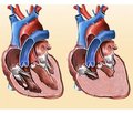 Дослідження впливу гуморальних запальних факторів у хворих на хронічну серцеву недостатність в поєднанні з цирозом печінки невірусного походження