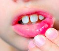 Результаты изучения гельминтоносительства как сопутствующей патологии у детей с герпетическим стоматитом
