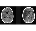 Clinical course and features of treatment of patients with ischemic stroke complicated by acute delirium