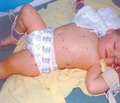 Case meningococcemia in a child is complicated by extensive necrosis of the skin