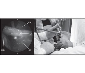 Магнітно-резонансна томографія в плануванні ендоскопічного доступу для денервації поперекових дуговідросткових суглобів