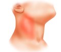 Relationship of the Parameters of Endogenous Intoxication with Fatty Acids in Patients with Phlegmons of the Maxillofacial Region