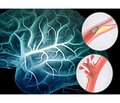 Influence of artificial therapeutic hypothermia on treatment results in patients with complicated intracranial aneurism hemorrhages