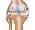 The changes of bone metabolism in gonarthrosis