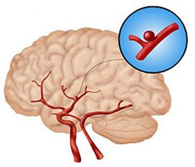 Influence of Artificial Therapeutic Hypothermia on Treatment Outcomes in Patients with Complicated Intracranial Aneurysmal Hemorrhages