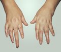 The onset and evolution characters of juvenile rheumatoid arthritis symptomatology during in the first year of its development.