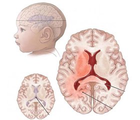 Наслідки інтра- й постнатальної ішемії мозку із психомовленневомоторною затримкою (Q04.9)