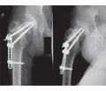 Reosteosynthesis in pseudarthrosis of the femoral neck
