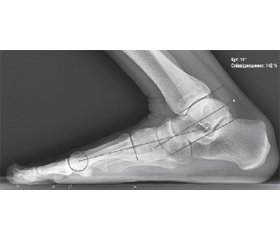 Comparative analysis of the validity of goniometric, inclinometric, and radiographic methods to measure ankle joint dorsiflexion