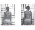 Biomechanical aspects of functional treatment of scoliotic spine deformation