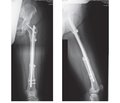 Східцеподібна остеотомія в разі алопластичного заміщення післярезекційних дефектів довгих кісток із застосуванням універсального інструмента