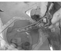 Удосконалення технологій ендопротезування кульшового суглоба з використанням трабекулярно-біонічної ніжки Physiohip
