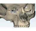 Нові підходи до екзопротезування орбіти з використанням СAD/CAM-технологій