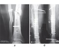 Можливості засобів для малоконтактного багатоплощинного остеосинтезу переломів гомілки й методик для його реалізації