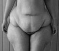 Біліопанкреатичне шунтування з дуоденальним виключенням у хворих із морбідним ожирінням: перший клінічний досвід
