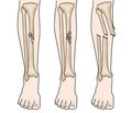Лікування діафізарних переломів кісток нижньої кінцівки методом БІОС при політравмі