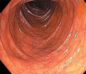 Современные возможности колонопротекции у пациентов с синдромом раздраженного кишечника