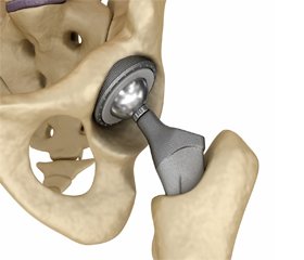 Тотальне ендопротезування кульшового суглоба протягом останніх 25 років