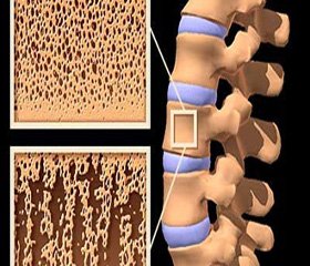 Патогенетическое обоснование применения бисфосфонатов при постменопаузальном остеопорозе