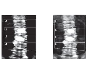 Мінеральна щільність кісткової тканини поперекового відділу хребта після проведення черезшкірної вертебропластики в пацієнтів з остеопорозом