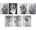 Особливості консервативного лікування хворих з післятравматичними контрактурами міжфалангових суглобів пальців кисті