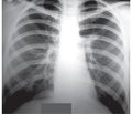 Ураження легень при вісцеральній формі токсокарозу в дітей у фтизіатричній практиці (клінічний випадок)