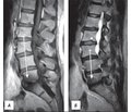 Изменения Modic в поясничном отделе позвоночника: гистология, факторы риска, клиническая картина и лечение