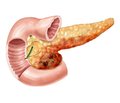 Хронічний панкреатит: про деякі ускладнення, особливості патогенезу та перебігу