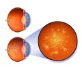 Чи можливо сповільнити розвиток діабетичної ретинопатії? Можливості неінвазивної терапії діабетичної ретинопатії при цукровому діабеті 2-го типу