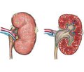 The Current Features of Pyelonephritis Etiological Structure in Children