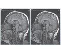 Псевдоинсультное течение аденомы гипофиза головного мозга: клиническое наблюдение