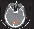 Венозний інфаркт потиличної частки головного мозку в пацієнта молодого віку (клінічний випадок)