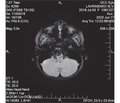 A clinical case of Louis-Bar syndrome with a clinical picture of cerebellar ataxia and EBV-associated lymphoproliferative syndrome