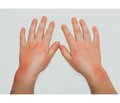 The role of skin microbiome in the development of atopic dermatitis in children