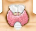 Ендемічний зоб (йододефіцитні захворювання)
