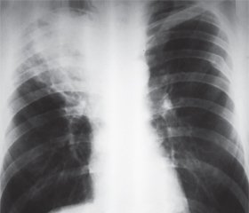 Трудности диагностики центральной эндофитной опухоли легкого, возникшей на фоне туберкулеза