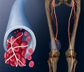 Питання лікування, вторинної профілактики тромбозу глибоких вен нижніх кінцівок і тромбоемболії легеневої артерії