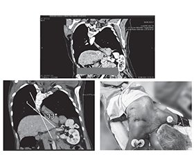 Клінічний випадок: мініінвазивна езофагектомія за McKeown у пацієнтки зі сколіозом ІІІ ступеня