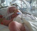 Бронхолегенева дисплазія   у недоношених новонароджених:   патогенез, клініка, лікування та профілактика (частина 1)  