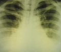 Clinical and diagnostic peculiarities of immunological adaptation in children in the first year of life ill with community–acquired pneumonia