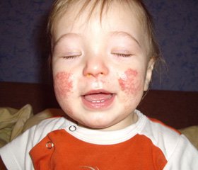 Зовнішня терапія атопічного дерматиту в дітей: сучасний погляд на проблему