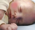 Значение антигистаминных препаратов при лечении аллергических заболеваний у детей